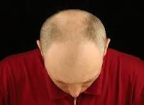 ತಲೆ ಬೋಳಾದರೆ ತಲೆಬಿಸಿ ಬೇಡ (ಭಾಗ 2)