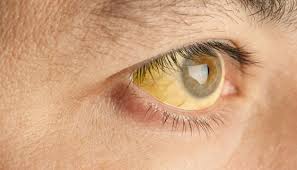 ಜಾಂಡಿಸ್ ಬಂದಾಗ ನಮ್ಮ ಕಣ್ಣು, ಚರ್ಮ ಹಳದಿ ಬಣ್ಣಕ್ಕೆ ತಿರುಗಲು ಕಾರಣವೇನು?